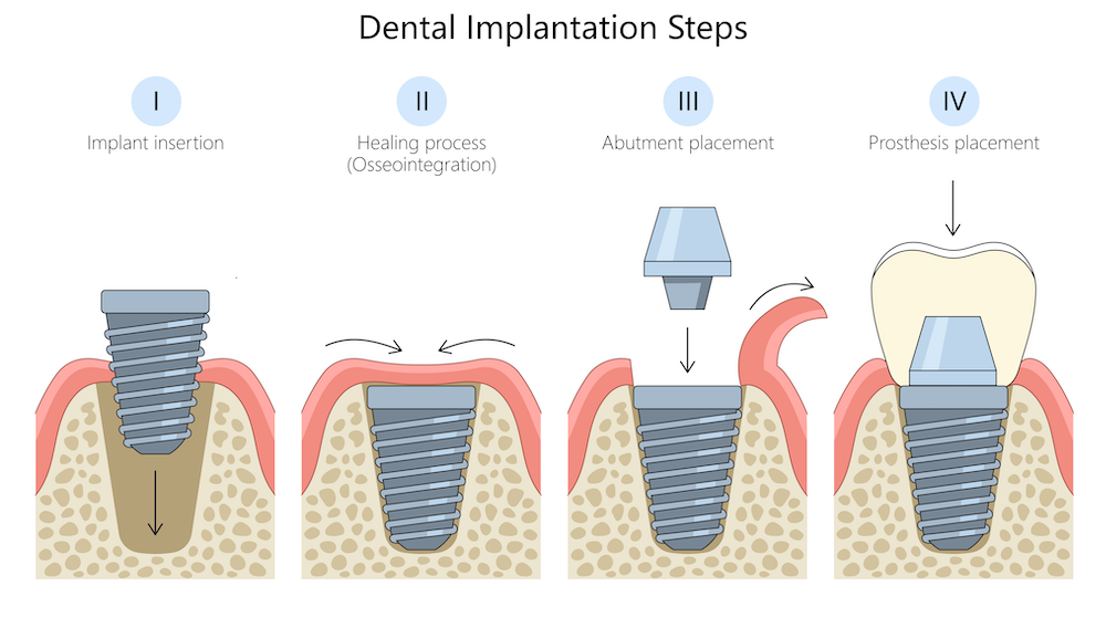 Dental Implant Procedures