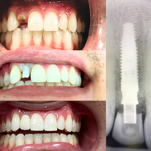 Dental Implant Therapy