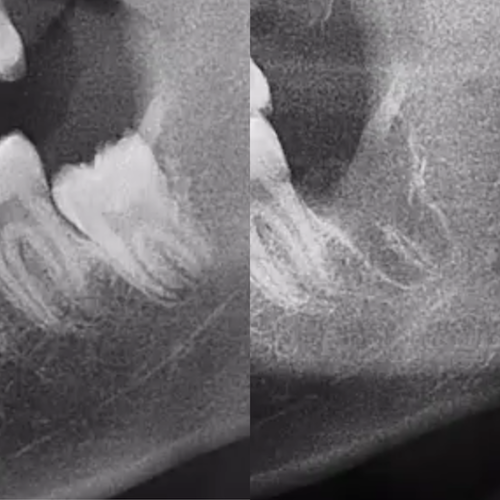 Wisdom Teeth Removal