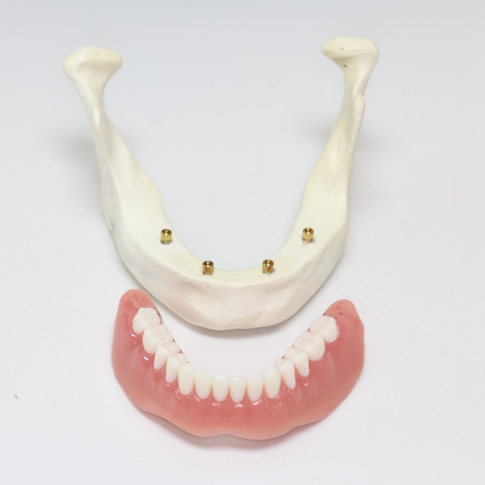 Holly Street Dental Services Implant Supported Dentures